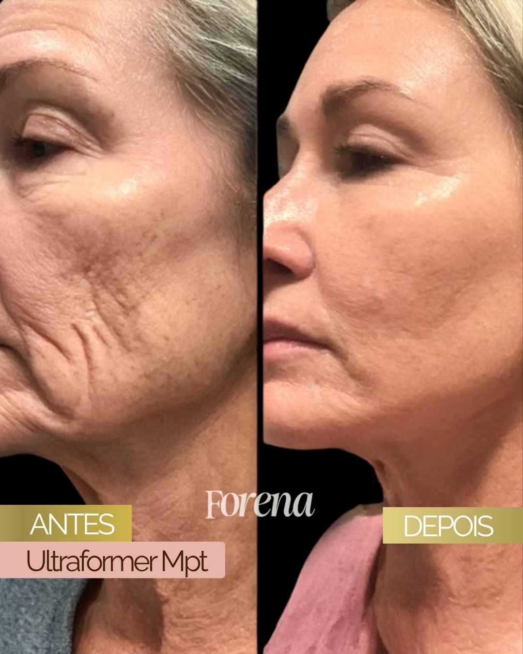 Comparação antes e depois de contorno facial fornecida pela FORENA