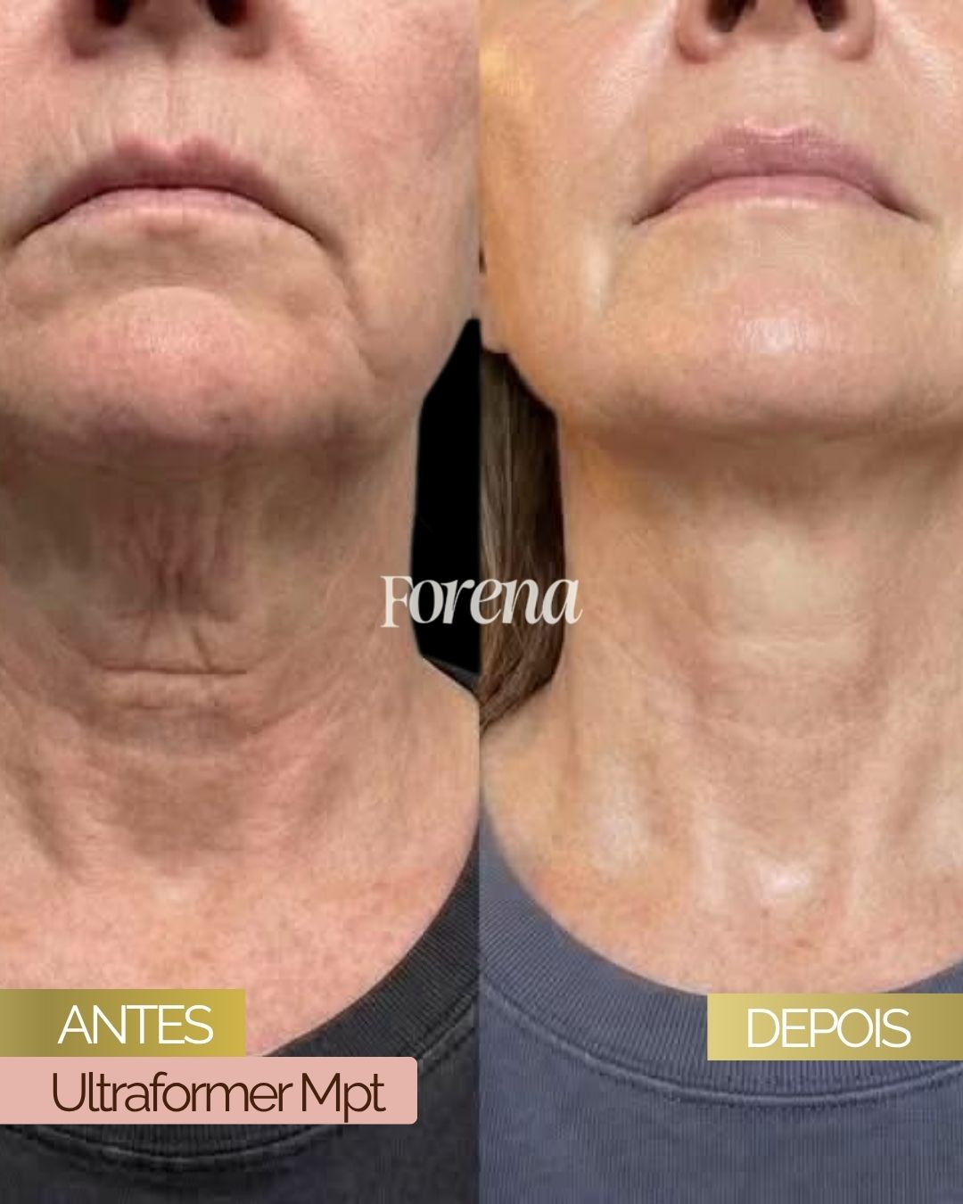 Comparação antes e depois da região abaixo do queixo fornecida pela FORENA